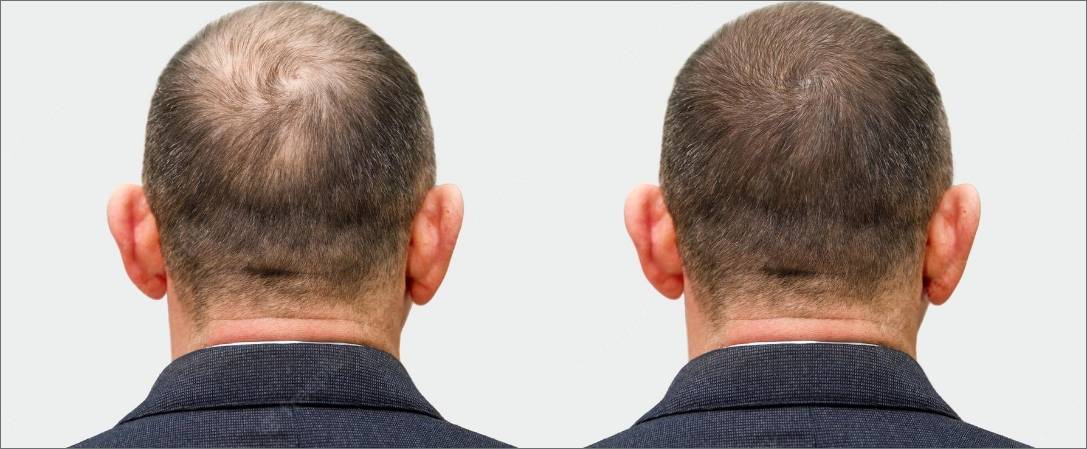 قبل و بعد از کاشت مو در کلینیک آسمان