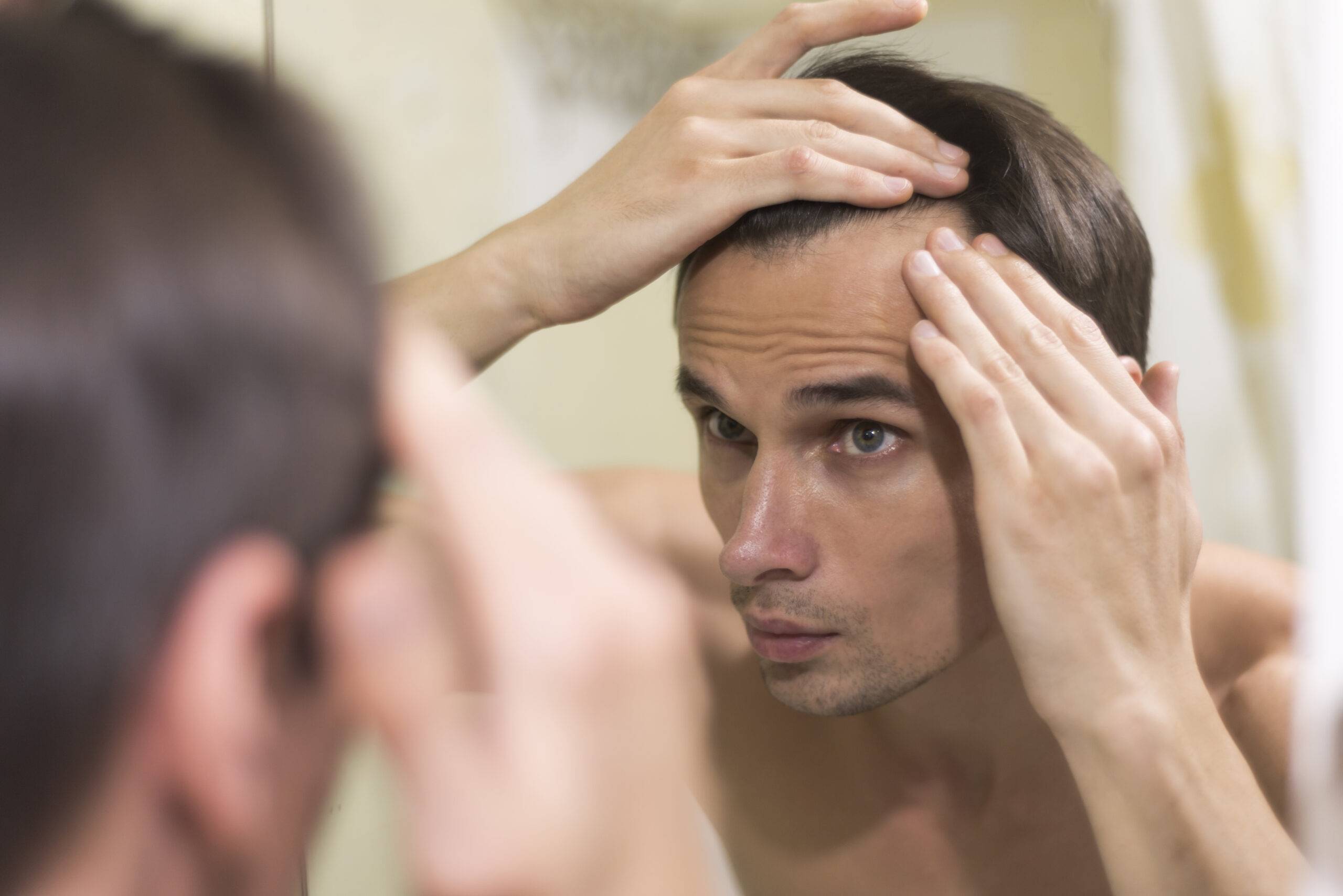 ریزش موی سکه ای در مردان