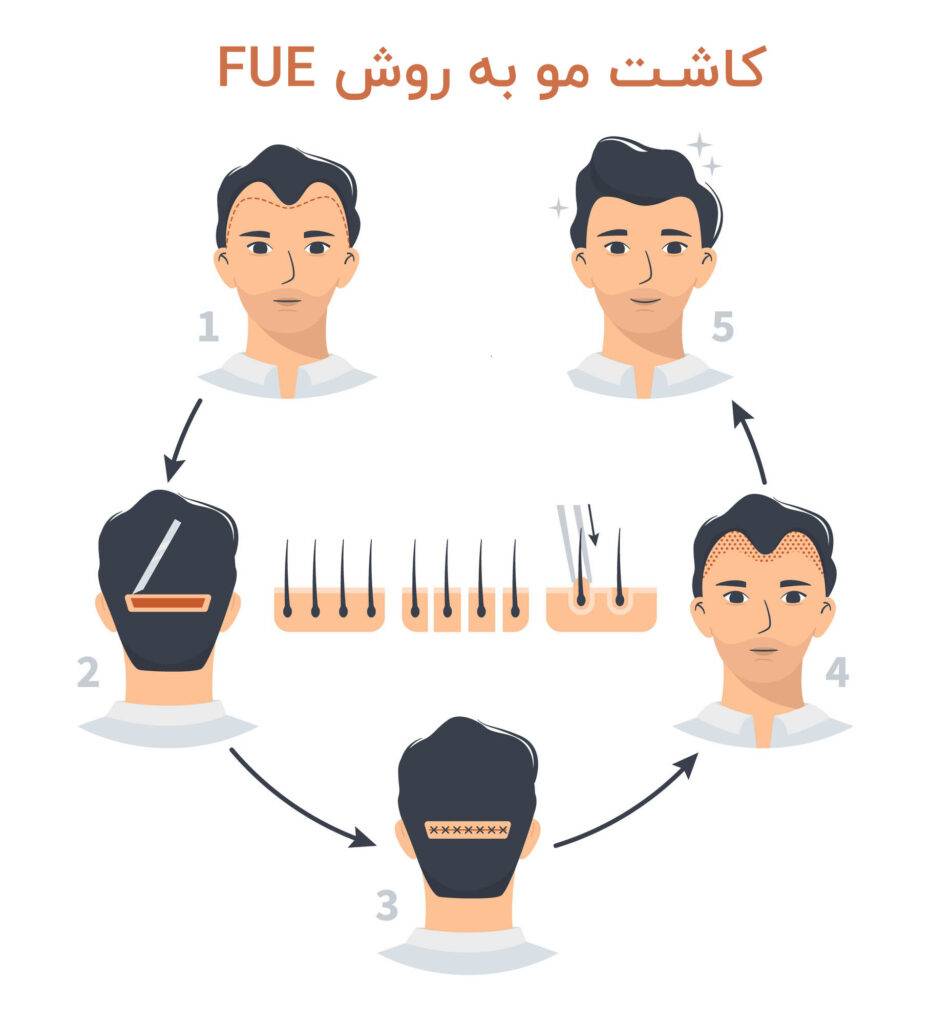 کاشت مو به روش FUE