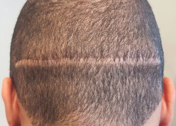 کاشت مو به روش FUT