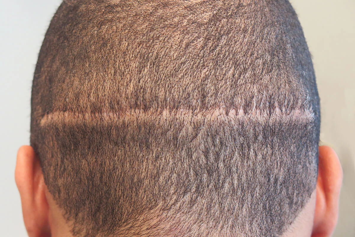 کاشت مو به روش FUT