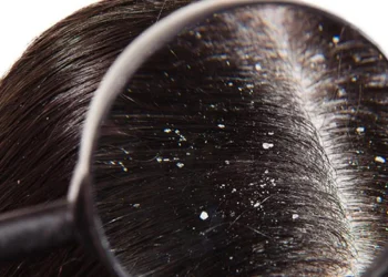 سفیدک های چسبیده به مو