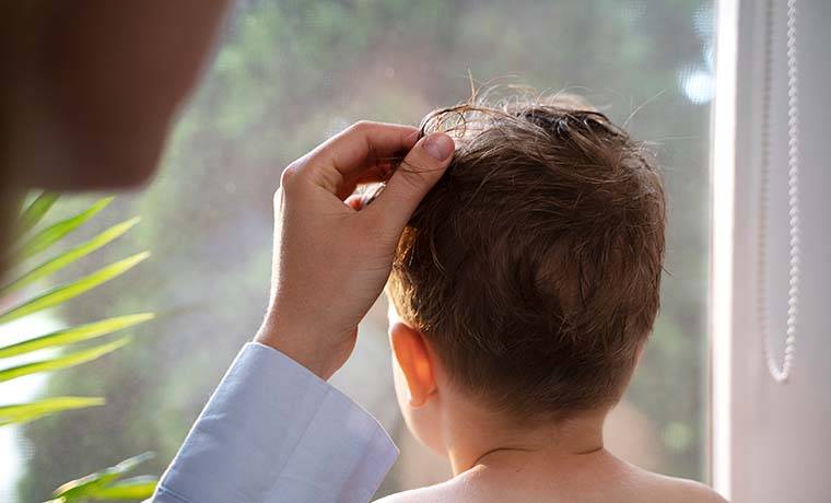 دلایل ریزش موی کودکان