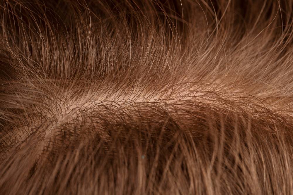 ریزش موی قارچی چیست؟