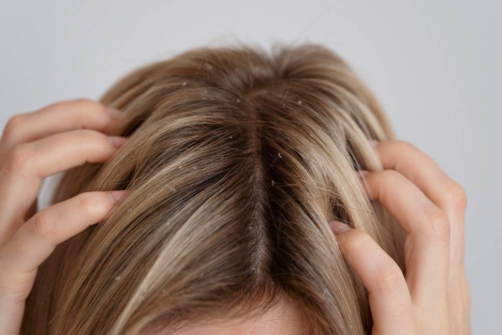 ریزش موی قارچی در زنان
