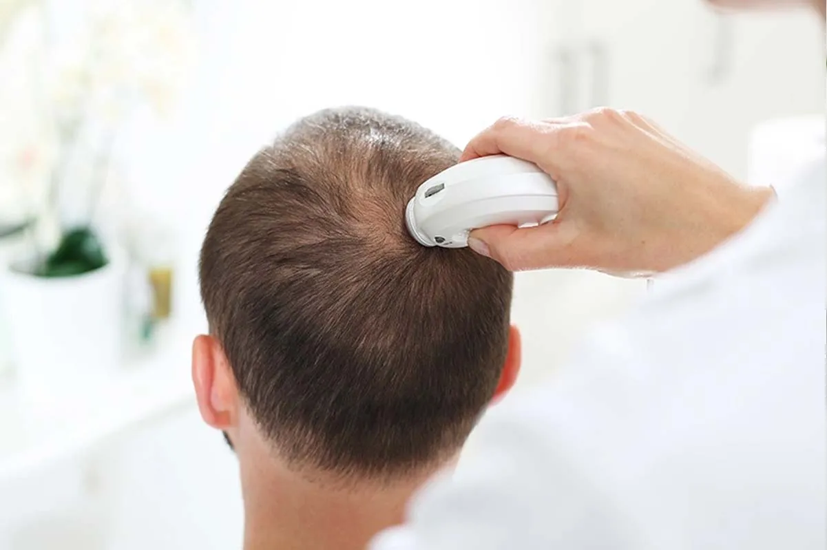 اهمیت آزمایش های قبل از کاشت مو