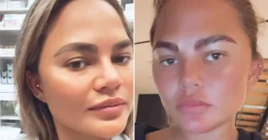 قبل و بعد کاشت ابرو