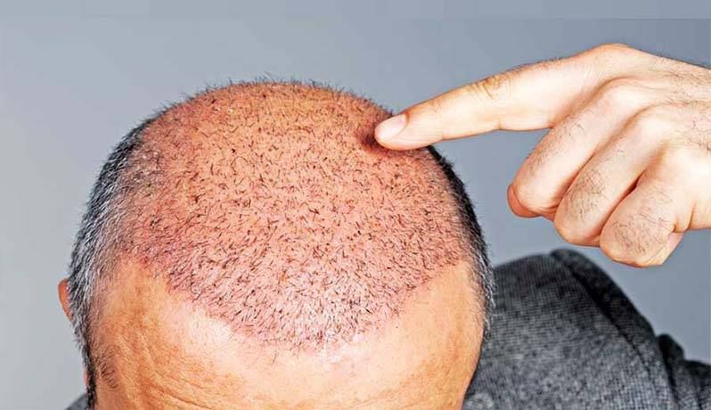 علت قرمزی پوست سر بعد از کاشت مو