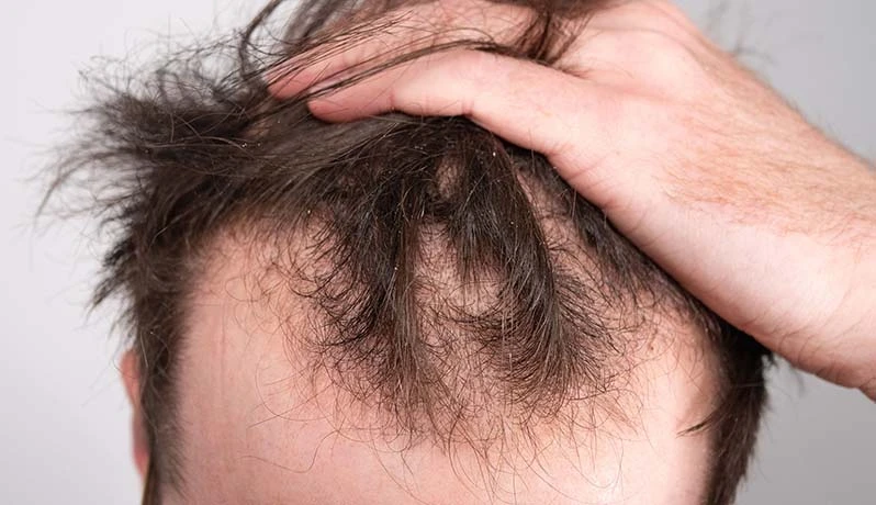 درمان انواع ریزش مو