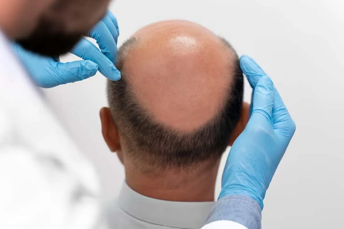 کاشت مو در ناحیه فرق سر یا ورتکس چگونه انجام می شود؟