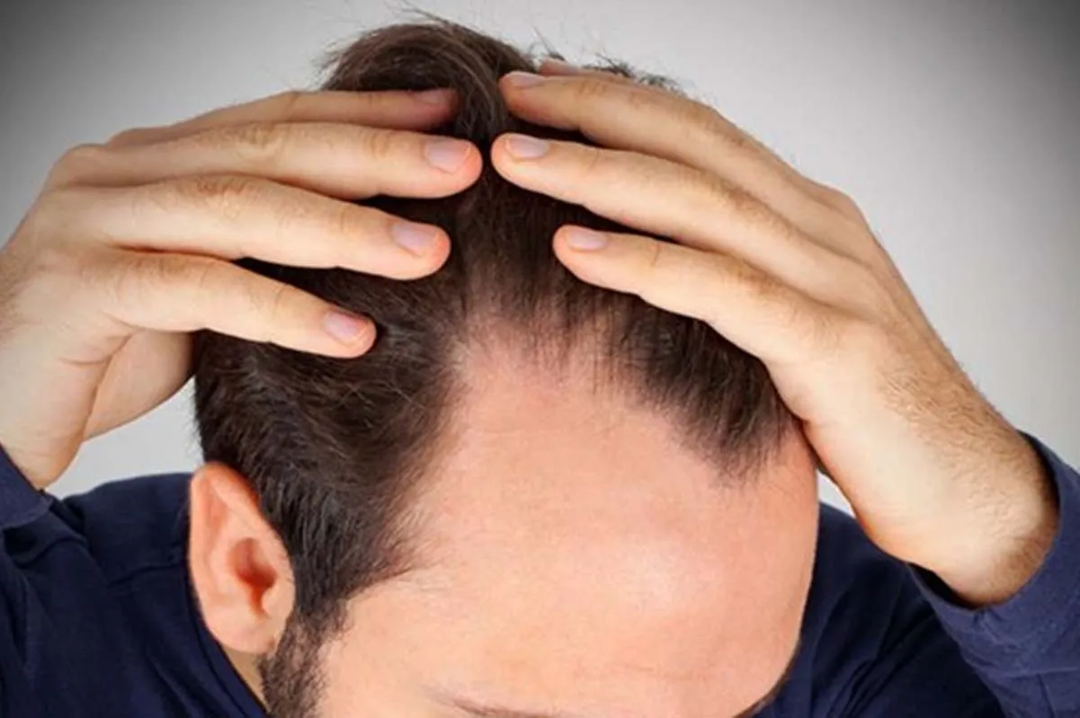 علائم ریزش مو در مردان