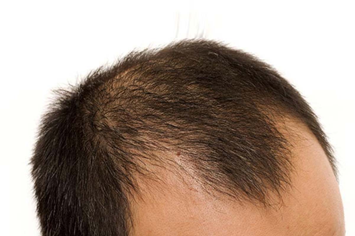 آشنایی با علائم و نشانه های ریزش مو در مردان و زنان