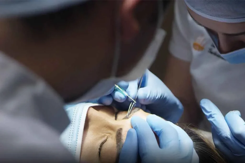 کاشت ابرو به روش FIT