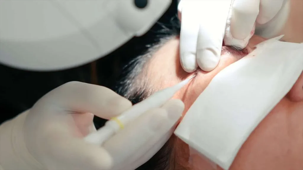 کاشت ابرو به روش sut