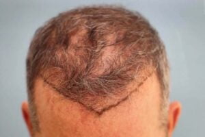 کاشت مجدد مو