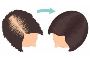 کاشت مو مصنوعی