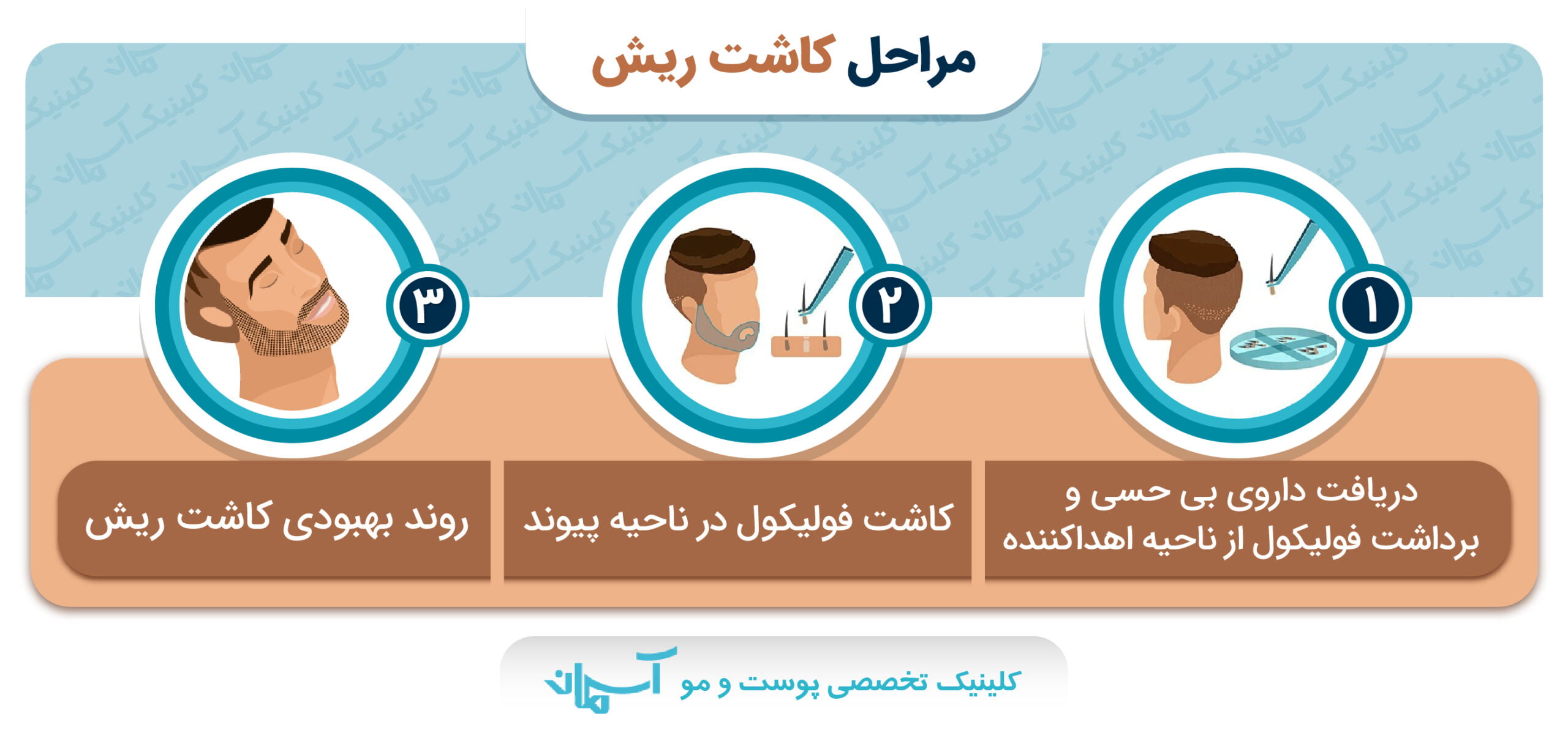 مراحل کاشت ریش