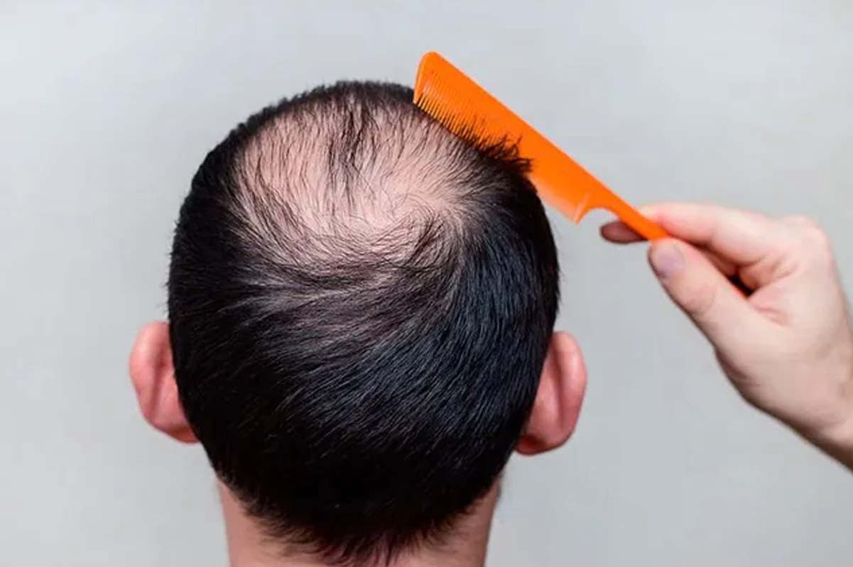 تکنیک های کاشت مو با تراکم بالا