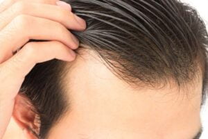 آیا بدون بانک مو میتوان کاشت مو انجام داد؟