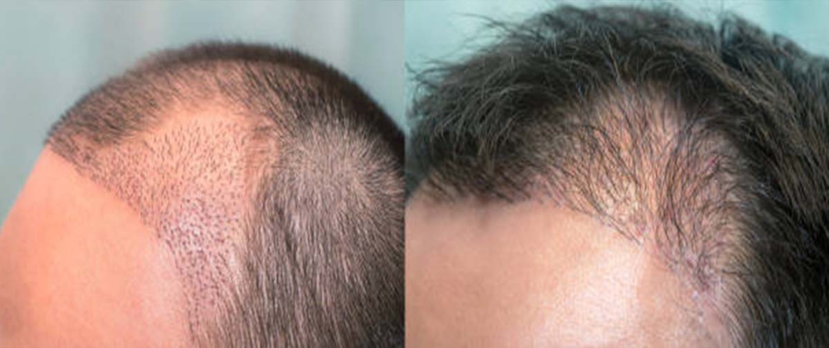 عوامل موثر بر تراکم کاشت مو پس از پیوند مو