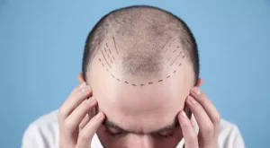 انواع الگوهای ریزش مو در مردان