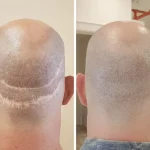 میکروپیگمنتیشن جای زخم